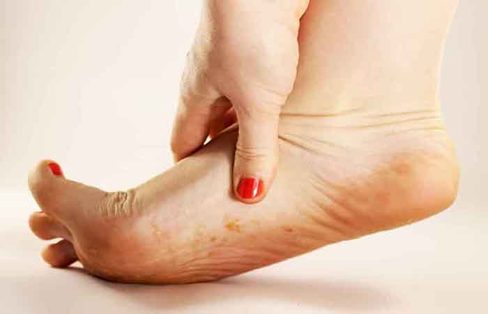 Mycosis of the foot: how to overcome it?