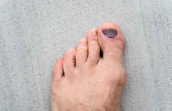 What causes a black toenail?