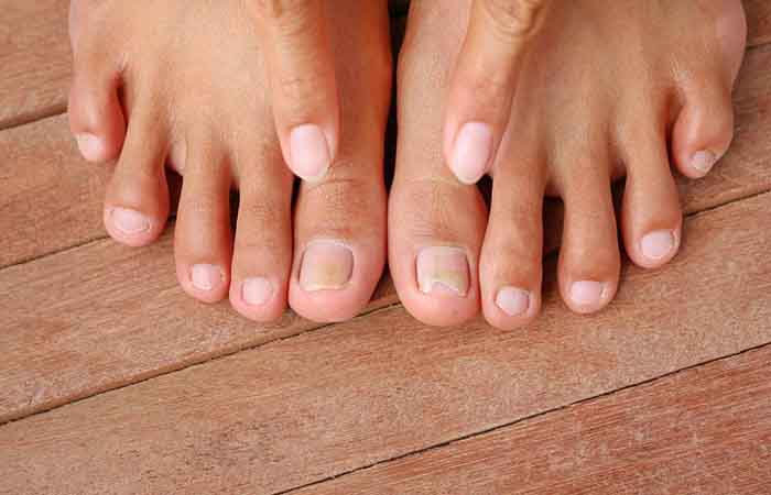 The things you need to know about toenail fungus