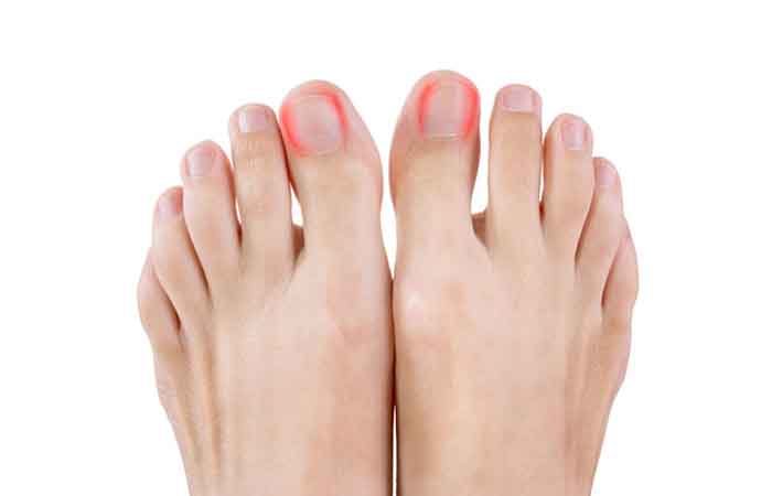 Complications of thick toenails