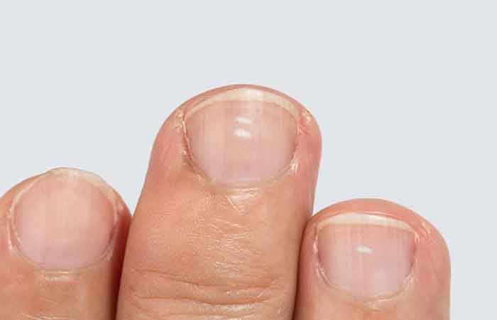 Why do we have white spots on the nails?