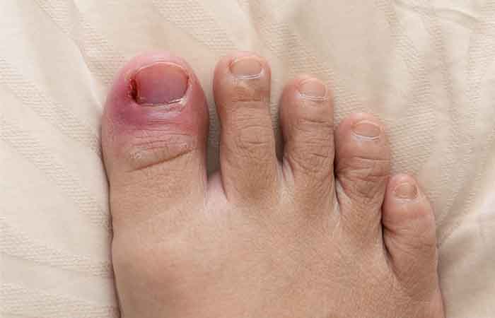 What is the causes of Ingrown Toenails?