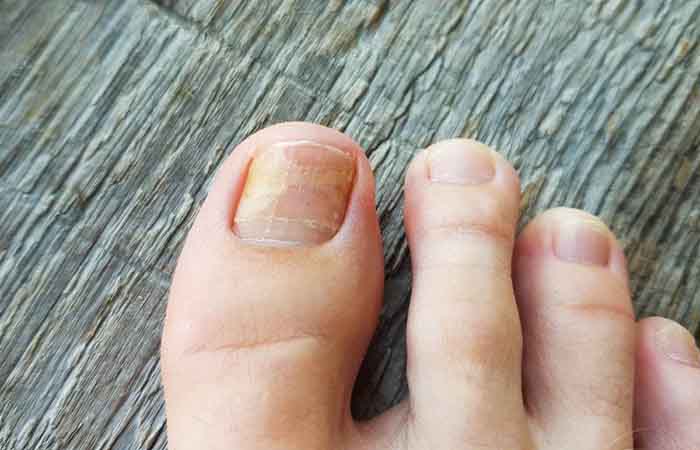 Care to take to prevent thickening of toenails