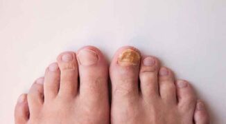 Nail,Fungus,On,Legs.,Nail,Disease.